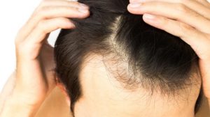 Which Technique of Hair Transplant has More acceptance: Why Medispa  